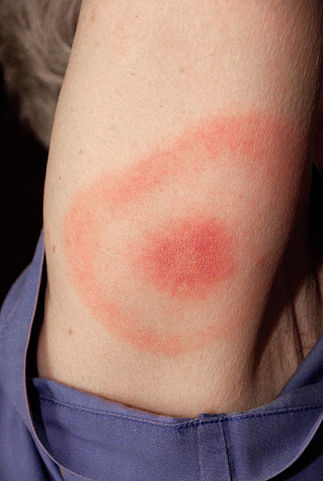 Typisk udslæt grundet borrelia efter et flåt bid. Foto James Gathany, Wikimedia